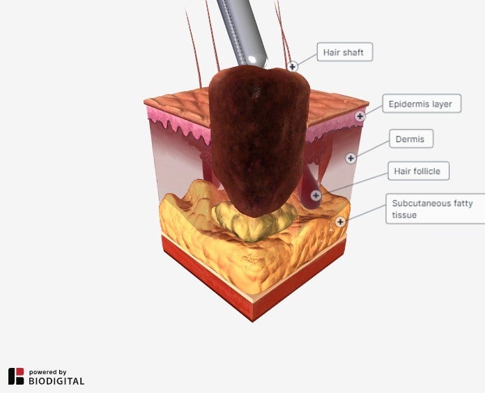 Cross section of a punch biopsy cutting through layers of skin.